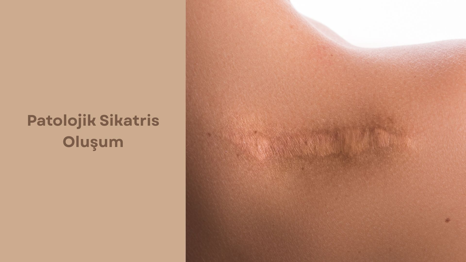 Patolojik Sikatris Oluşum