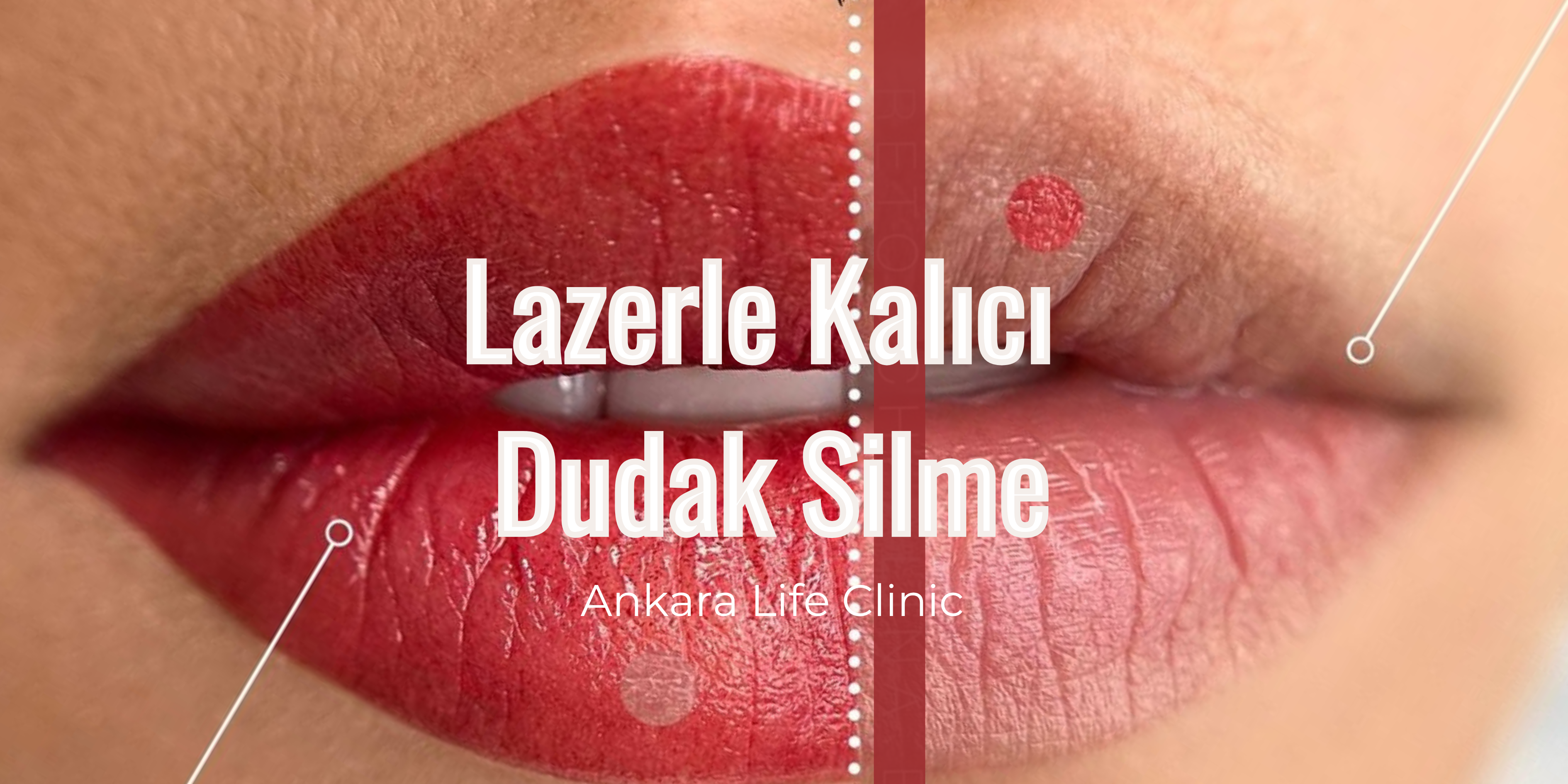 Altın İğne ile Yara İzi Tedavisi  